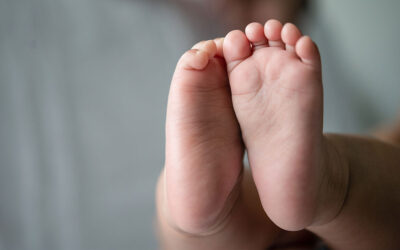 My child has a club foot. Can I claim for this?